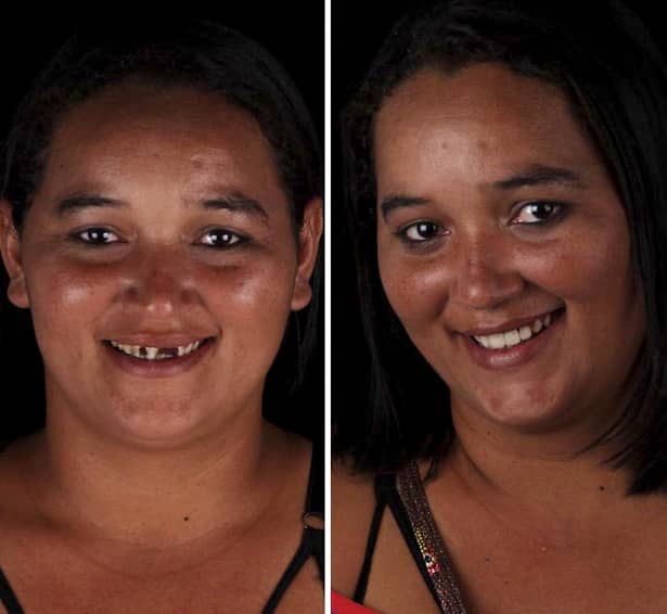 Un stomatolog brazilian îi ajută pe cei sărmani să își facă dinții. Galerie foto cu oamenii cărora le-a schimbat aspectul fizic