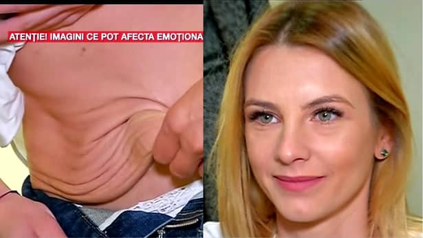 Adina Bourceanu şi-a tăiat excesul de piele, operaţie care a costat 5.500 de euro