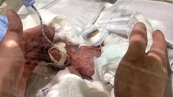 Cel mai mic băiețel din lume, care cântărea 268 de grame la naștere, a fost externat! Cât a stat în spital