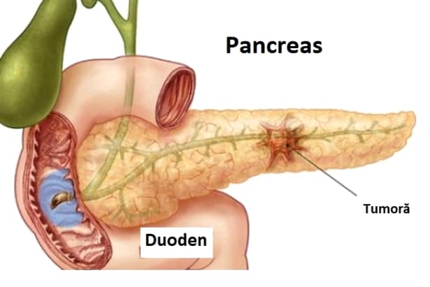 Cancerul pancreatic: care sunt simptomele și cum recunoaștem această boală