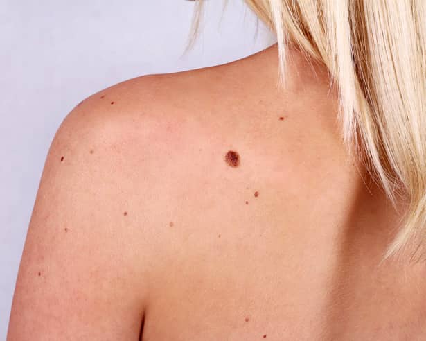 Ce este cancerul de piele: simptome, diagnostic și tratament. Iată primele semne