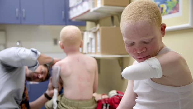Albinos de 17 ani, ucis într-un ritual sinistru! Motivul incredibil pentru care i-au luat părţi din corp!