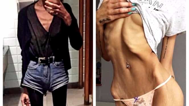 A fost la un pas de moarte din cauza anorexiei! După un an în care s-a ”tratat” cu pizza, tânăra arată AŞA