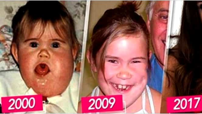 S-a născut cu o boală rară ce-i mutila chipul, iar medicii nu-i mai dădeau şanse de supravieţuire! Acum are 21 de ani şi arată AŞA!