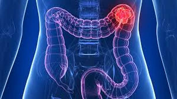Ce este cancerul de colon? Cum poți depista tumorile, diagnostic și tratament