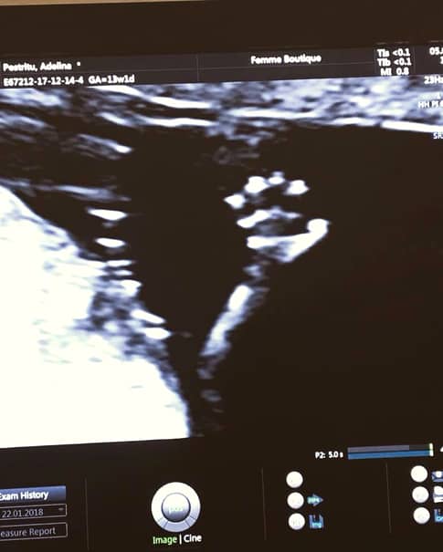 Primele imagini cu burtica de gravidă a Adelinei Pestriţu! Cât de mult s-a îngrăşat