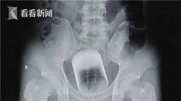 O radiografie face înconjurul lumii! S-a distrat o noapte întreagă, dar i-a fost ruşine să mărturisească medicului: ce obiect avea blocat în bazin!