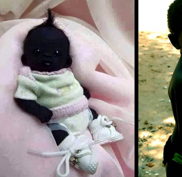 Cel mai negru copil din lume a crescut mare!  CE TRANSFORMARE! Cum arată acum