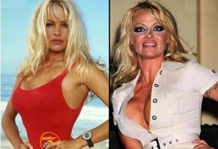 Pamela Anderson a fost una dintre cele mai apreciate femei din lume, dar odată cu înaintarea în vârstă, se pare că operațiile estetice au dus-o mai aproape de eșec decât de frumusețe
