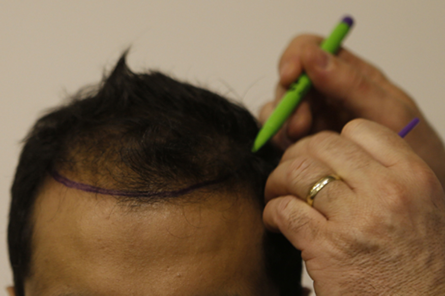 Implantul de păr nu este o operație lipsită de riscuri